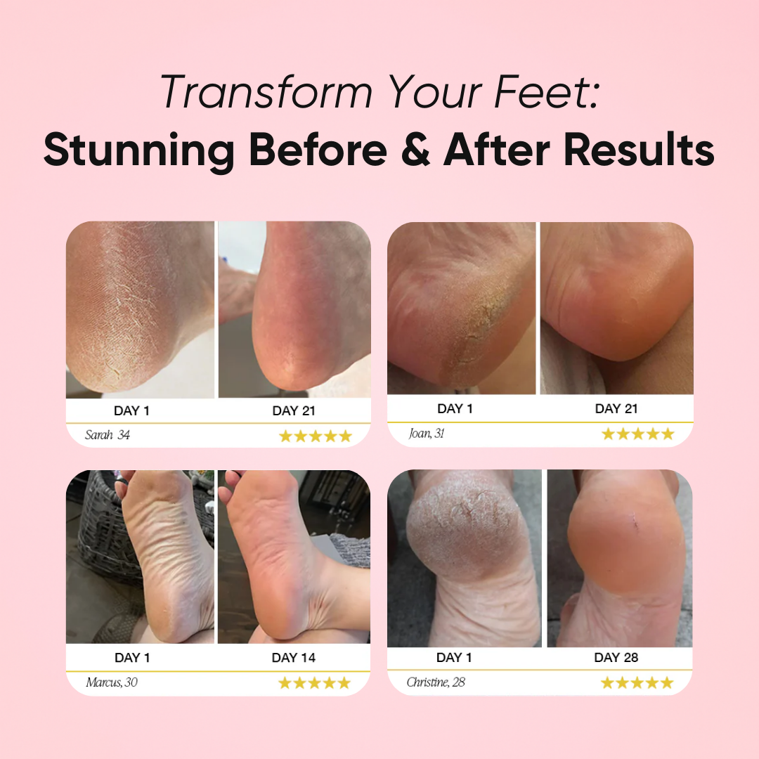 Venus Callus BeGone™ Roller Edition