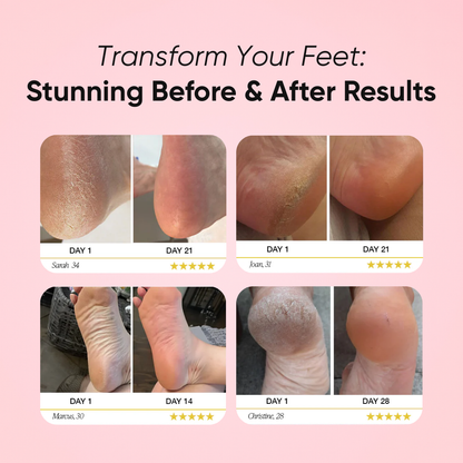 Venus Callus BeGone™ Roller Edition